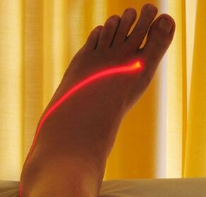 лазерне лікування варикозу на ногах