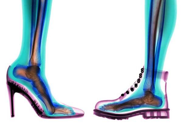 зручне та незручне взуття для профілактики варикозу