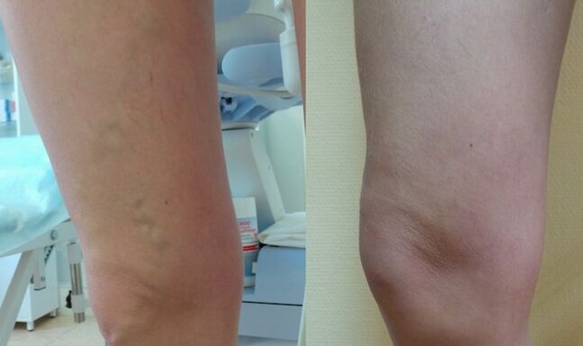 нога до та після лікування ретикулярного варикозу
