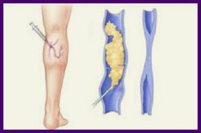 Склеротерапія – популярний метод позбавлення від варикозу на ногах