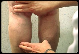Лікар оглядає ноги з варикозним розширенням вен