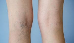 ознаки варикозного розширення вен на ногах у жінок